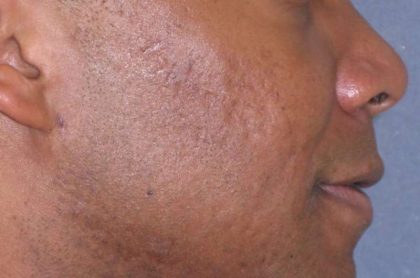 Fraxel Restore Acne Scarring Before & After Patient #682