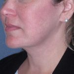 Deep Plane Lower Face & Neck Lift Before & After Patient #947