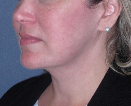Deep Plane Lower Face & Neck Lift Before & After Patient #947