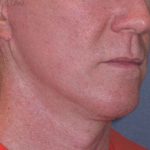 Deep Plane Mini Lift & Neck Lift Before & After Patient #965