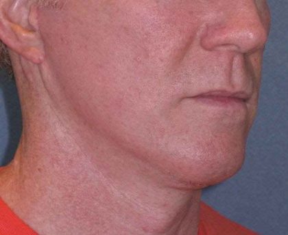Deep Plane Mini Lift & Neck Lift Before & After Patient #965