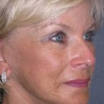 Deep Plane Mini Lift & Neck Lift Before & After Patient #972