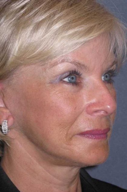 Deep Plane Mini Lift & Neck Lift Before & After Patient #972
