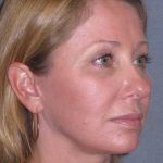 Deep Plane Mini Lift & Neck Lift Before & After Patient #981