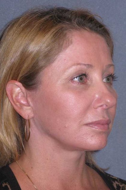 Deep Plane Mini Lift & Neck Lift Before & After Patient #981