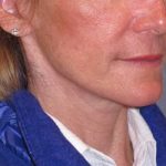 Deep Plane Mini Lift & Neck Lift Before & After Patient #988