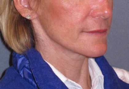 Deep Plane Mini Lift & Neck Lift Before & After Patient #988