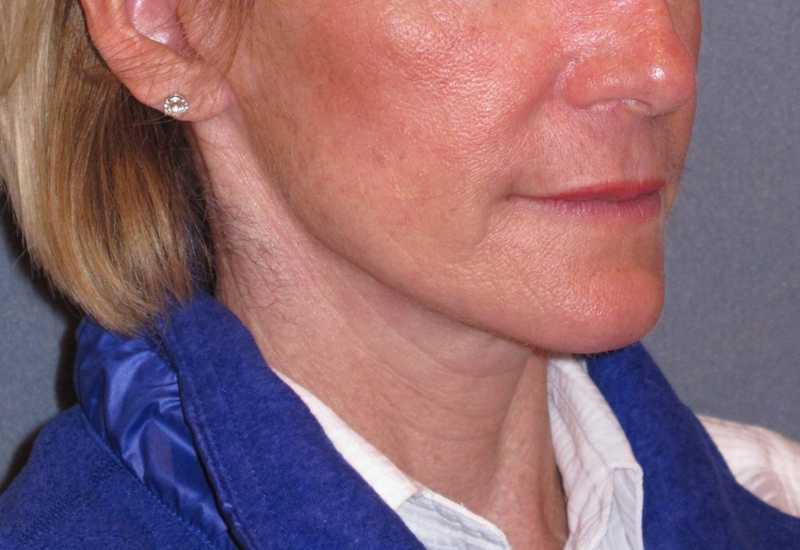 Deep Plane Mini Lift & Neck Lift Before & After Patient #988