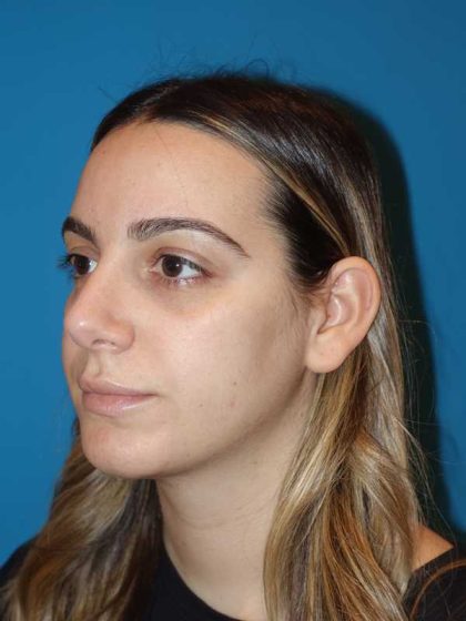 Neck Liposuction Before & After Patient #999