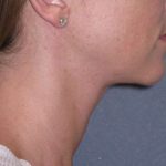 Neck Lift Before & After Patient #1007