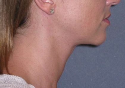 Neck Lift Before & After Patient #1007
