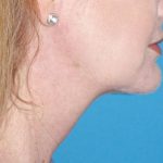 Neck Lift Before & After Patient #1018