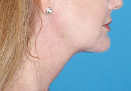 Neck Lift Before & After Patient #1018