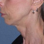 Deep Plane Mini Lift & Neck Lift Before & After Patient #1023