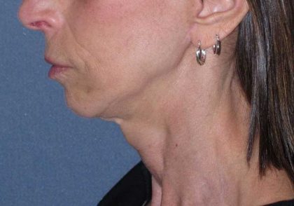 Deep Plane Mini Lift & Neck Lift Before & After Patient #1023