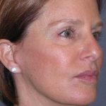Deep Plane Mini Lift & Neck Lift Before & After Patient #1030