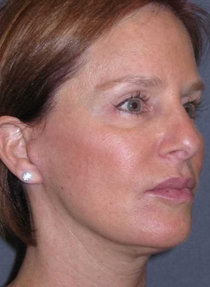 Deep Plane Mini Lift & Neck Lift Before & After Patient #1030