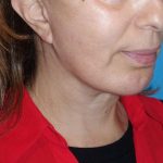 Deep Plane Lower Face & Neck Lift Before & After Patient #1041