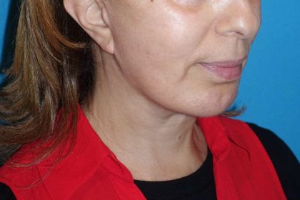 Deep Plane Lower Face & Neck Lift Before & After Patient #1041