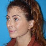 Deep Plane Lower Face & Neck Lift Before & After Patient #1052