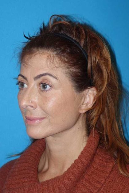 Deep Plane Lower Face & Neck Lift Before & After Patient #1052