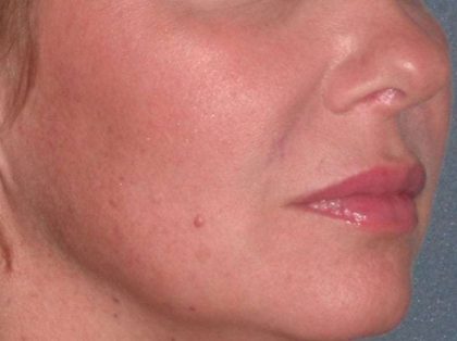 Juvéderm - Lips Before & After Patient #659