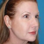 FaceTite Before & After Patient #704