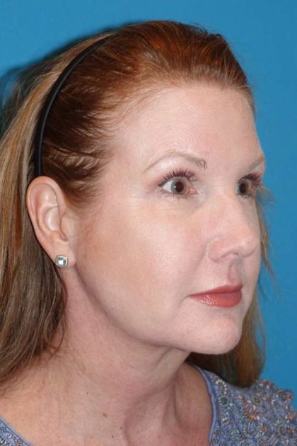 FaceTite Before & After Patient #704