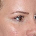 Eyelid Lift- Lower Before & After Patient #731