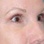 Eyelid Lift- Lower Before & After Patient #742
