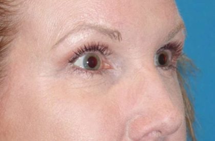 Eyelid Lift- Lower Before & After Patient #742