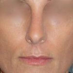 Rhinoplasty Before & After Patient #798