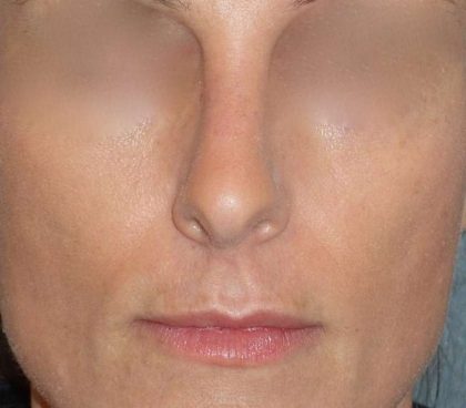 Rhinoplasty Before & After Patient #798