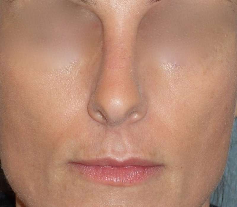 Rhinoplasty Before & After Patient #798