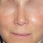 Rhinoplasty Before & After Patient #809