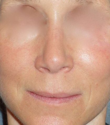 Rhinoplasty Before & After Patient #809