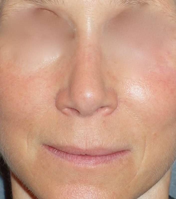 Rhinoplasty Before & After Patient #809