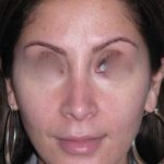 Rhinoplasty Before & After Patient #816