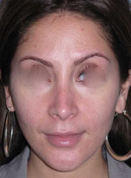 Rhinoplasty Before & After Patient #816