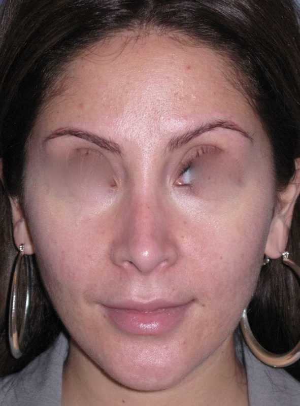 Rhinoplasty Before & After Patient #816