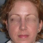 Rhinoplasty Before & After Patient #823