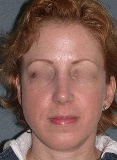 Rhinoplasty Before & After Patient #823