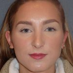 Rhinoplasty Before & After Patient #845