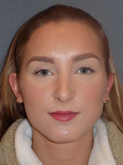 Rhinoplasty Before & After Patient #845