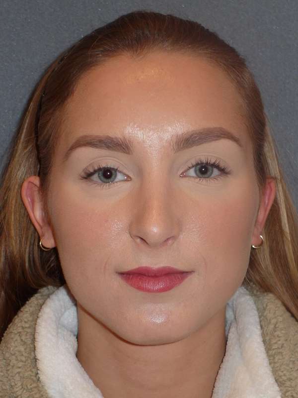 Rhinoplasty Before & After Patient #845