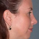 Fraxel Restore Before & After Patient #677