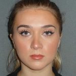 Rhinoplasty Before & After Patient #856