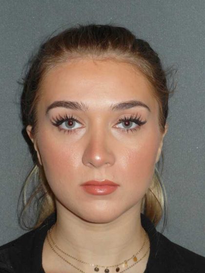 Rhinoplasty Before & After Patient #856