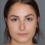 Rhinoplasty Before & After Patient #867
