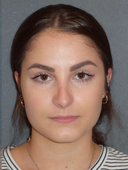 Rhinoplasty Before & After Patient #867